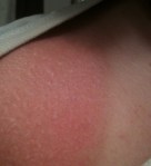 My sunburn